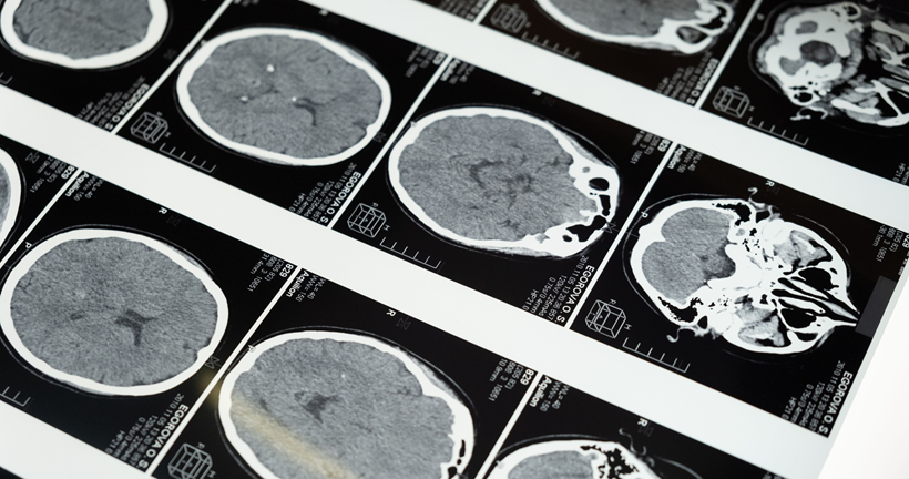ADAM10: una vía menos conocida para entender mejor el Alzheimer